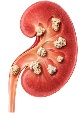 Medical diagram of a human kidney showing kidney stones in the calyces and ureter